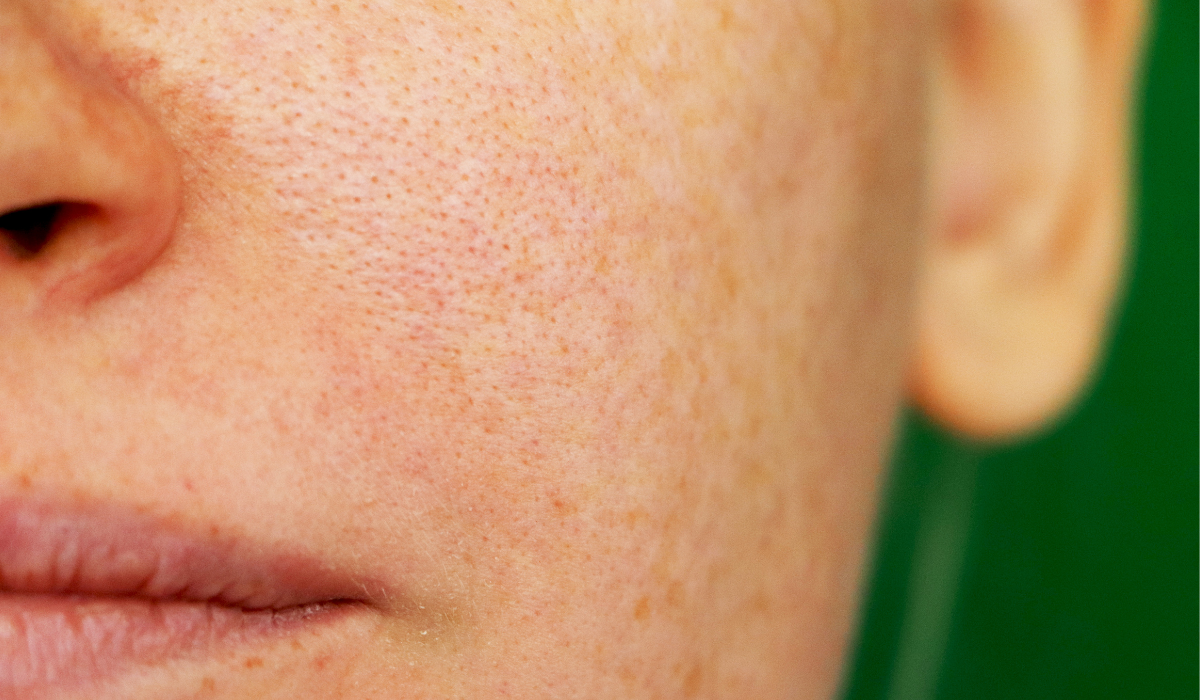 A close-up of pigmentation on a woman's face